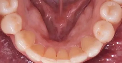 After - Braces at 123 iSmile