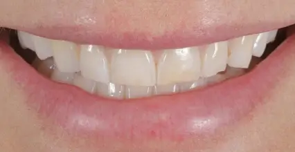 Before - Veneers at 123 iSmile