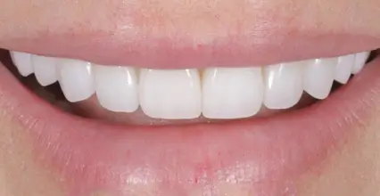 After - Veneers at 123 iSmile