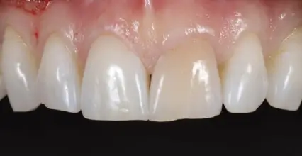 Before - Invisalign at 123 iSmile