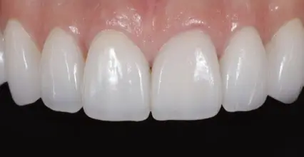 After - Invisalign at 123 iSmile