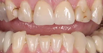Before - Braces at 123 iSmile