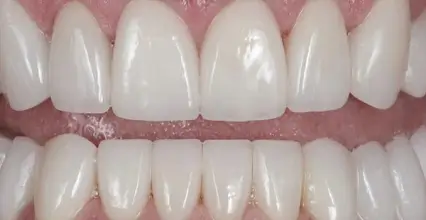 After - Braces at 123 iSmile