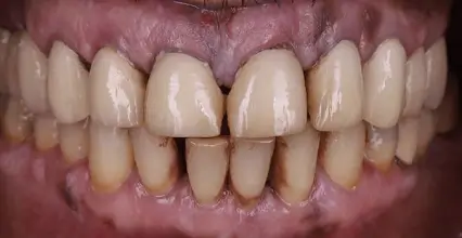Before - Veneers at 123 iSmile