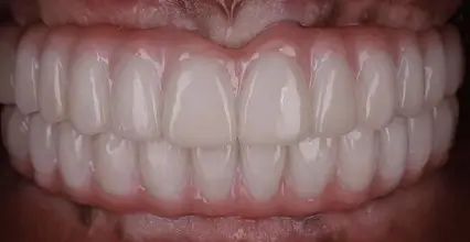 After - Veneers at 123 iSmile