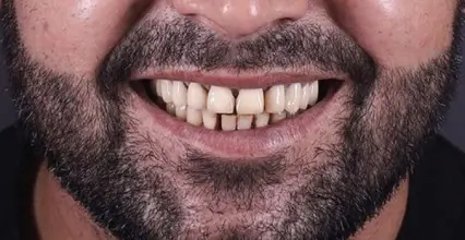 Before - Invisalign at 123 iSmile