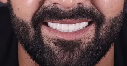After - Invisalign at 123 iSmile