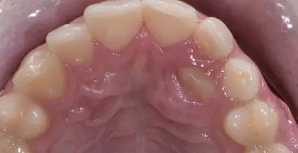 Before - Braces at 123 iSmile