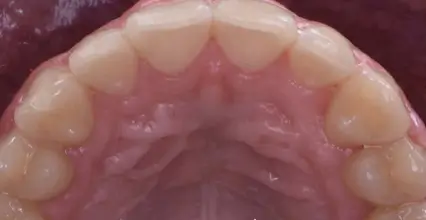 After - Braces at 123 iSmile
