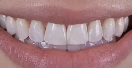 Before - Veneers at 123 iSmile