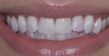 After - Veneers at 123 iSmile