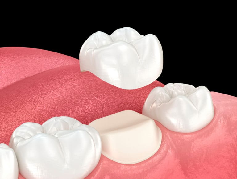 When should you consider a dental crown? — 123 iSmile Modesto CA