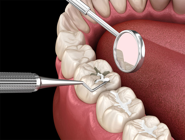 Who can benefit from dental sealants? — 123 iSmile Modesto CA