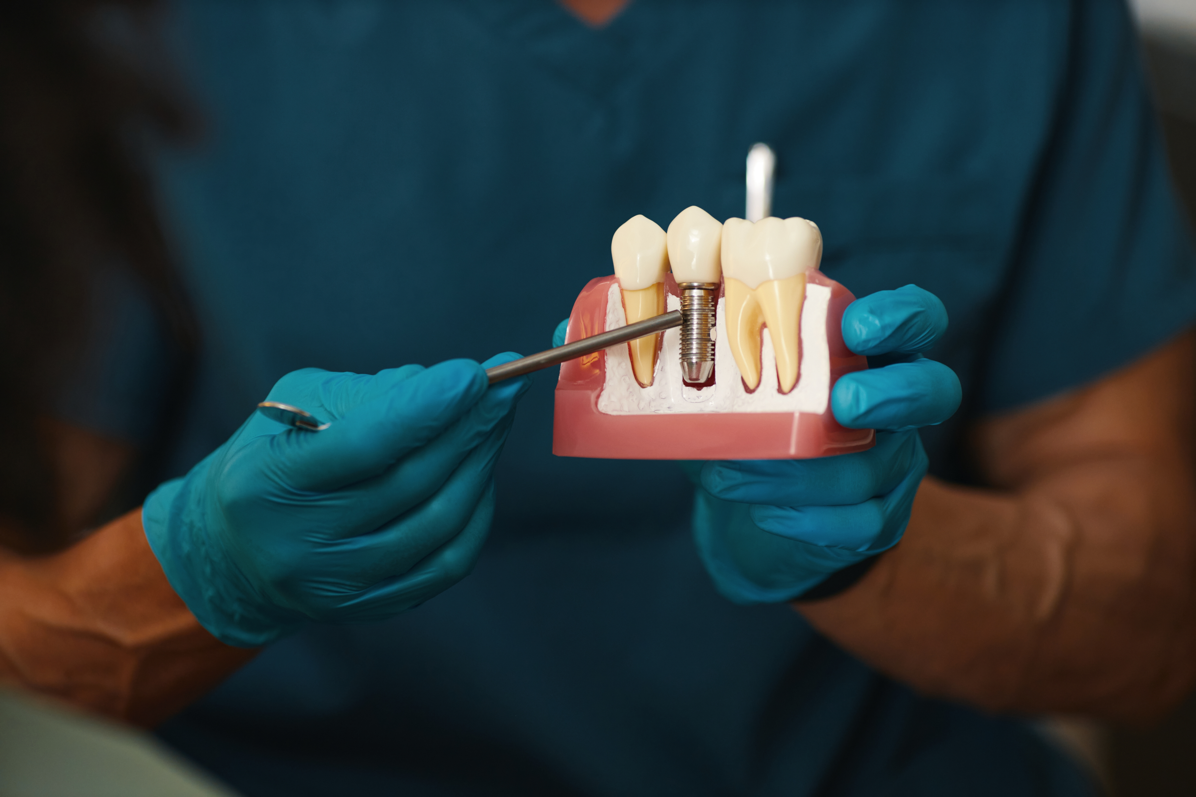 Dental Veneers