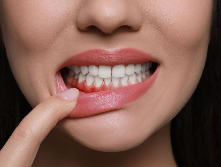 Gum Disease Treatment — 123 iSmile Modesto CA