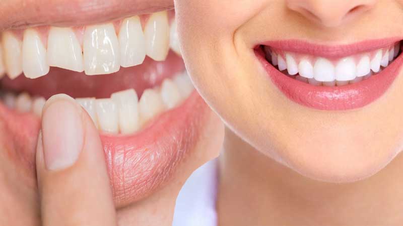 Enhance Your Smile: Cosmetic Dentistry Options at 123 iSmile