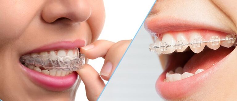 Achieve a Straighter Smile: Invisalign and ClearCorrect at 123 iSmile