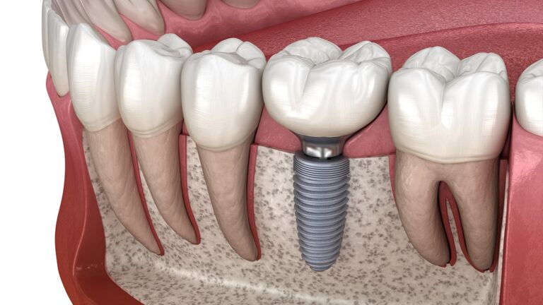 Your Guide to Dental Implants: Restoring Smiles at 123 iSmile